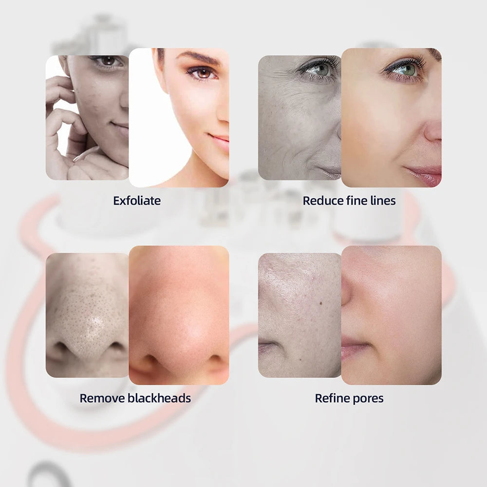 Diamond Facial Peeling Machine Home Use