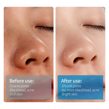 Small Bubble Blackhead Remover Facial Cleansing